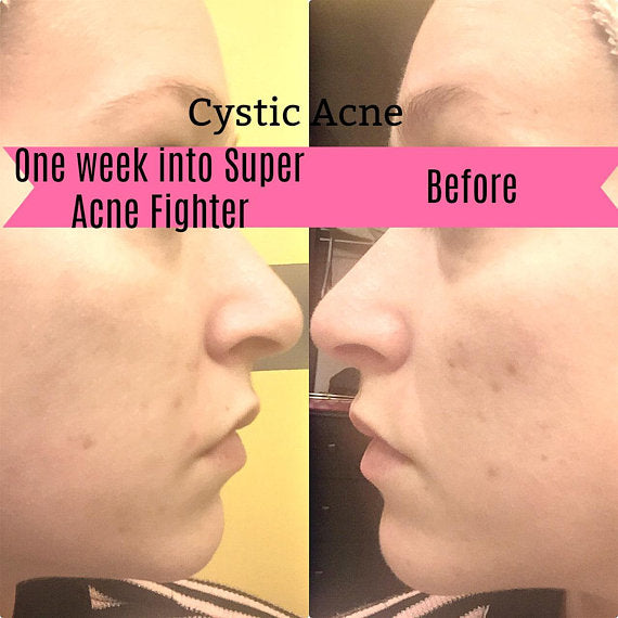 Organic Acne Skin Treatment